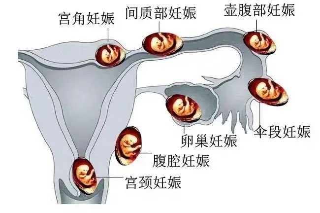 45岁的女人检查有一个卵泡做试管有多少成功怀孕的机会